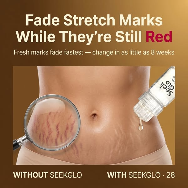 Stretch Marks? Try This At Home