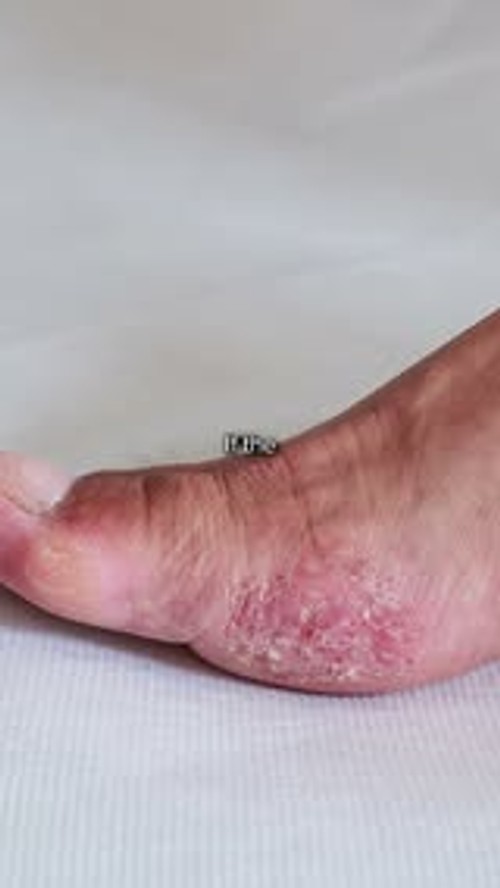 Eliminate Athlete’s Foot Today.