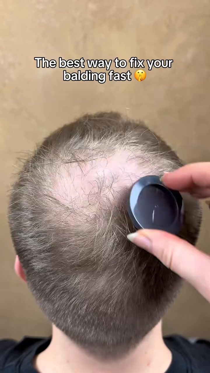 Beat Hairloss Today