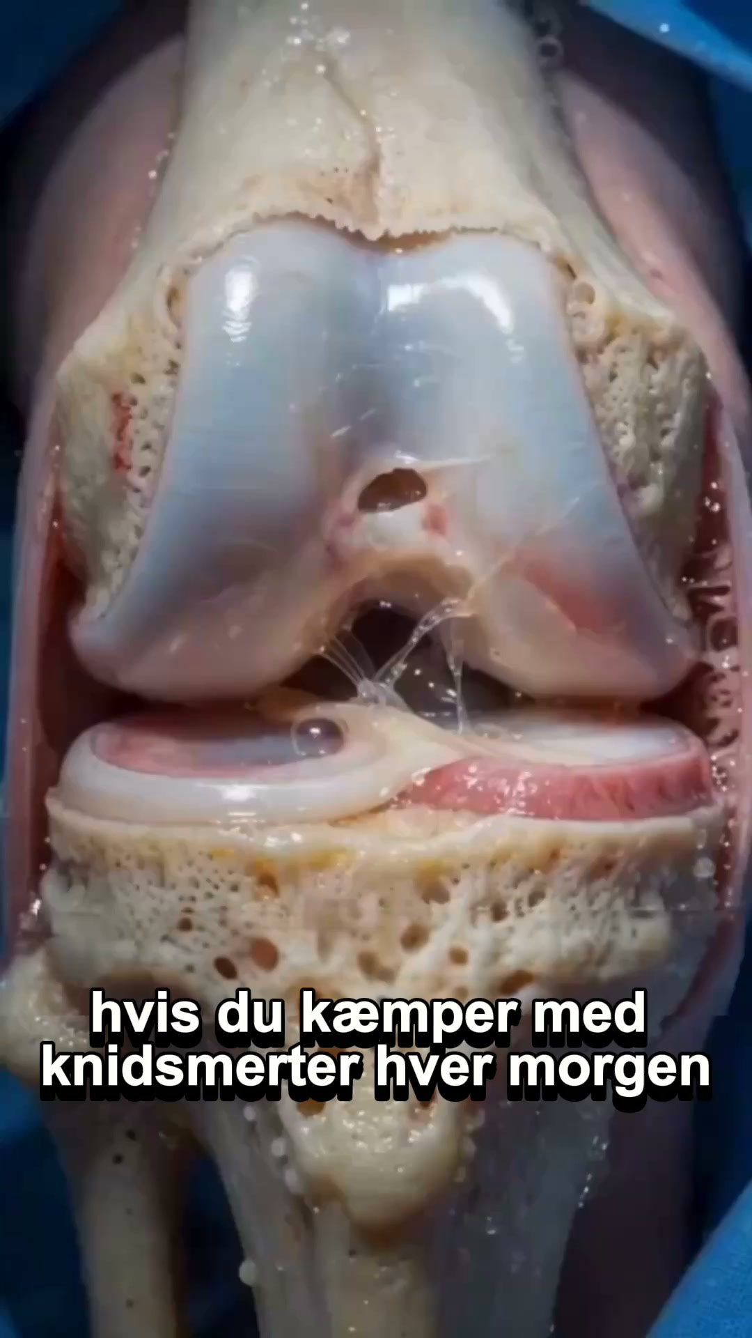 Kroniske knæsmerter eller ustabile led?