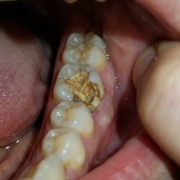 Read this if you have a damaged enamel...