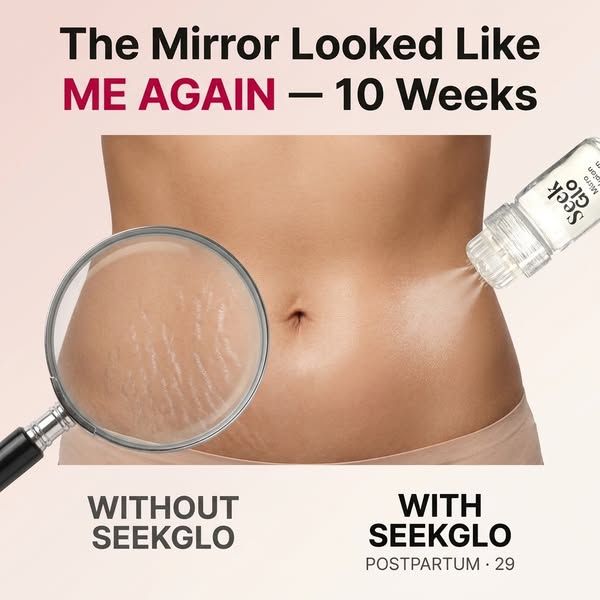 Stretch Marks? Try This At Home