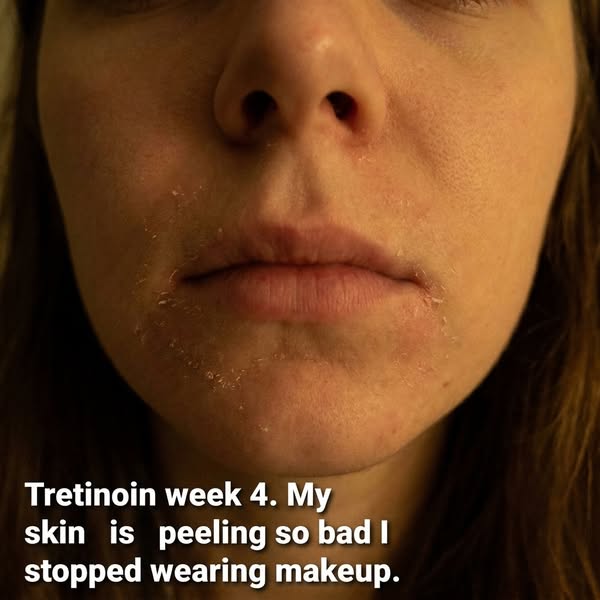 Your chin and mouth peel first on tretinoin because the barrier is thinnest there. One thing fixed it.