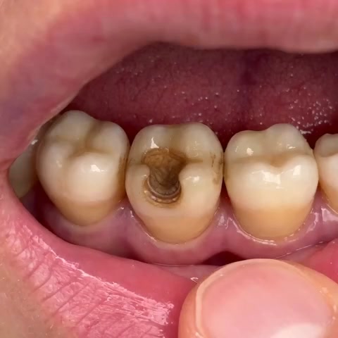 Cavity Repair FDA-Recognized 10% Nano-Hydroxyapatite (NH-10) | Delivery within 2-4 working days | Full refund guarantee