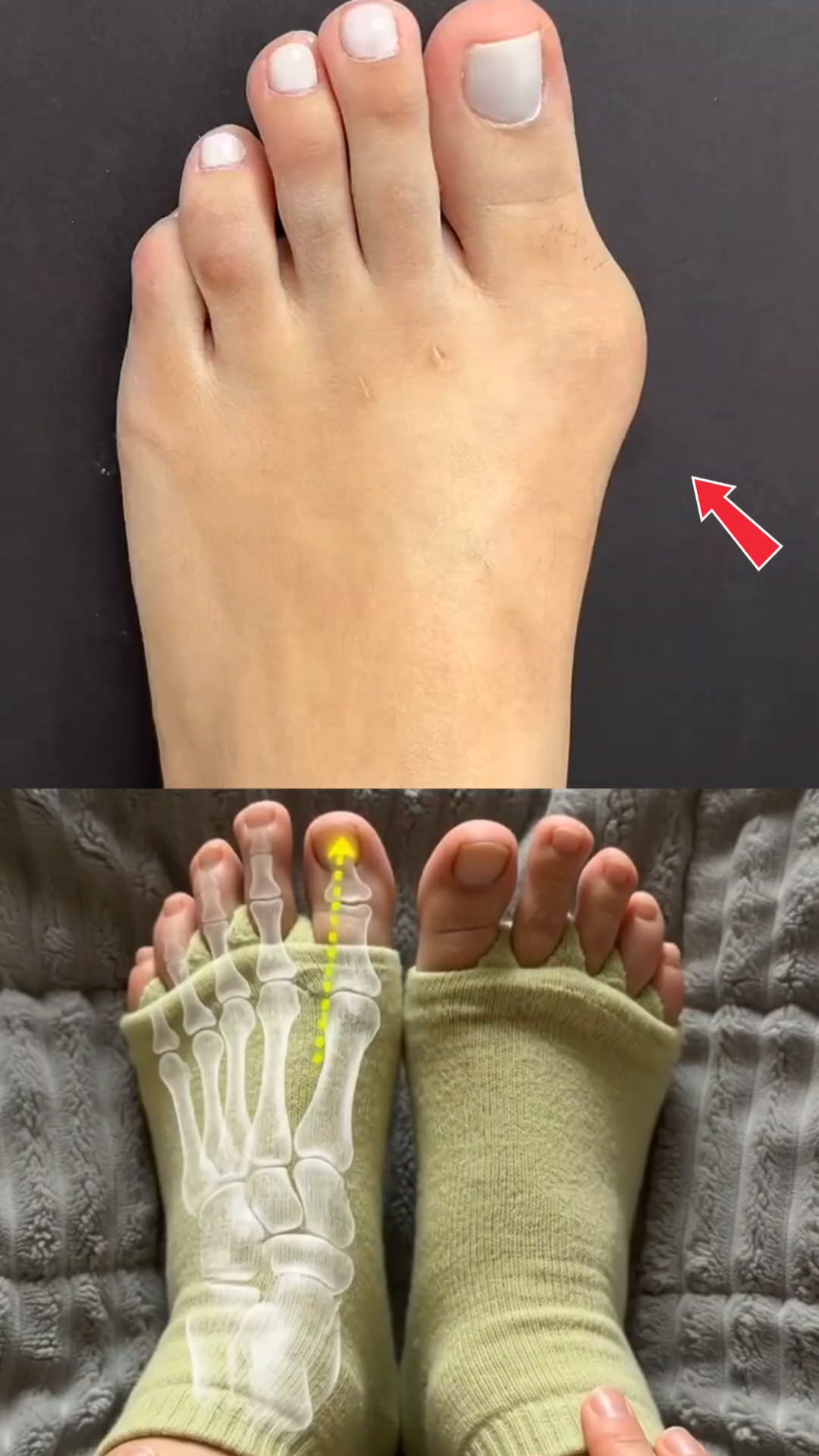 Fix Bunion Pain Today