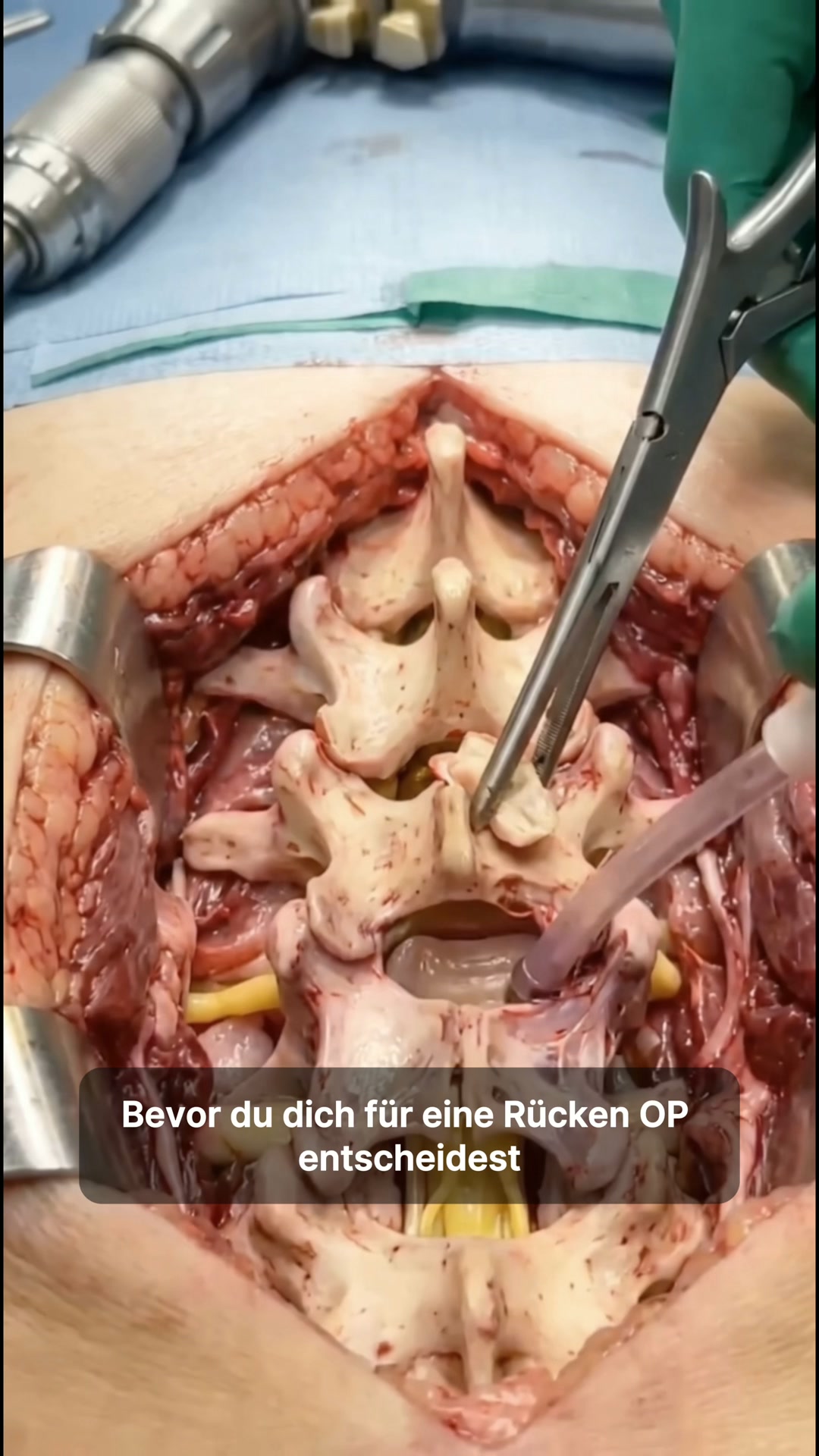 Rückenschmerzen? Deswegen ist eine OP ein Fehler