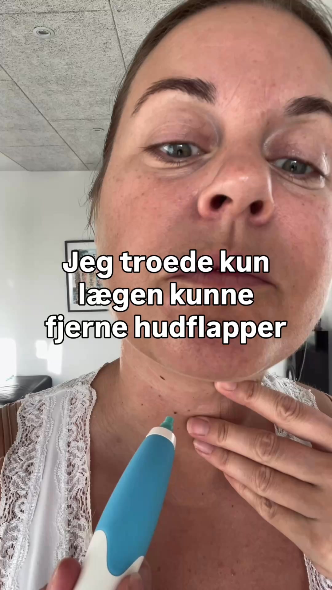 Slip af med hudflapper nemt