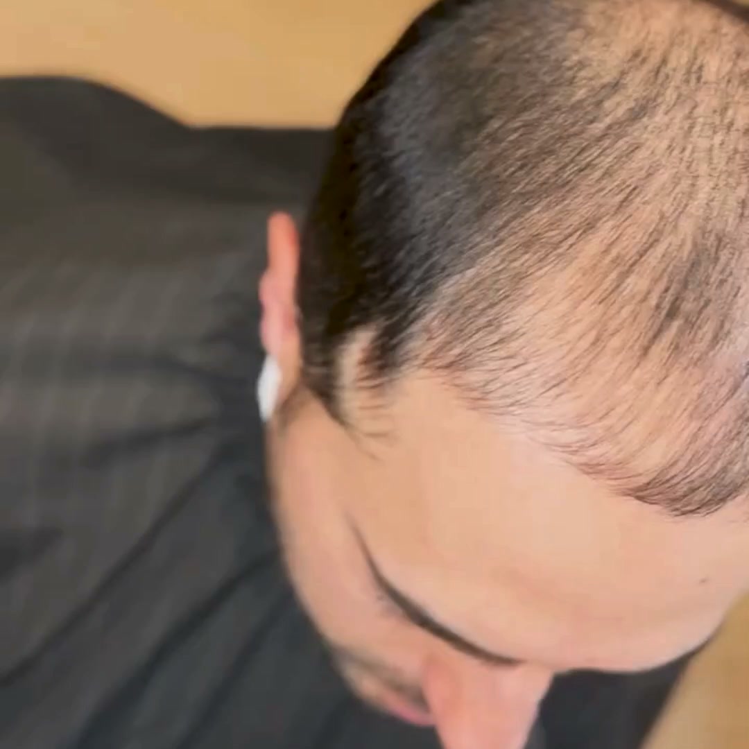 Hair Transplant