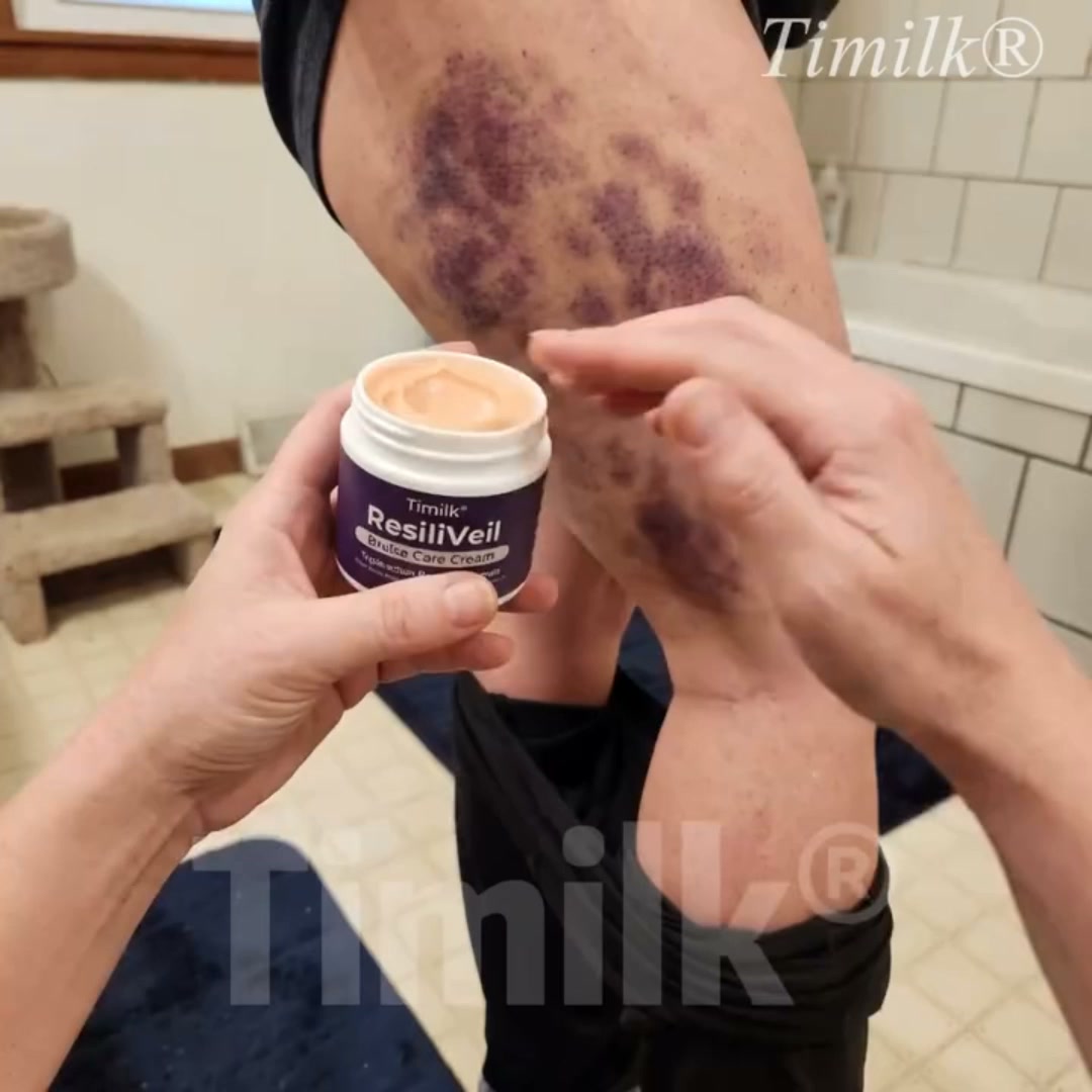 Stubborn Bruises? Try This 5-Minute Remedy