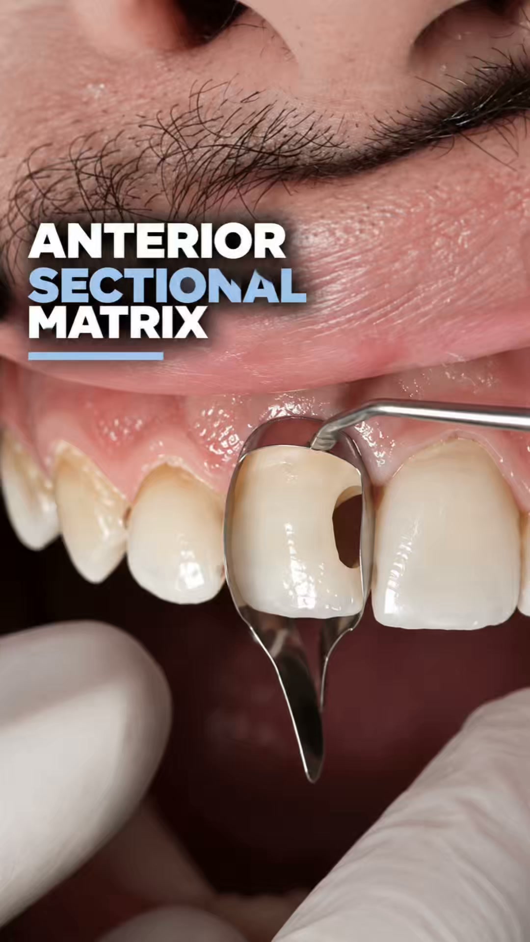 Anterior Sectional Matrices, Done Right