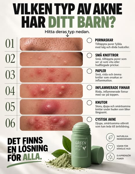 Minska akne naturligt