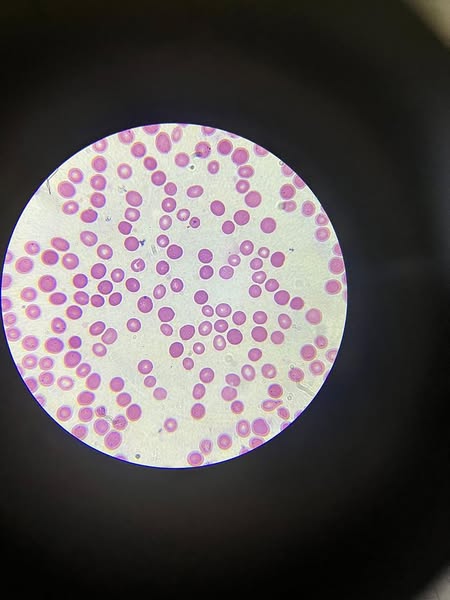 Cholesterol Is Damaging Your Kidneys