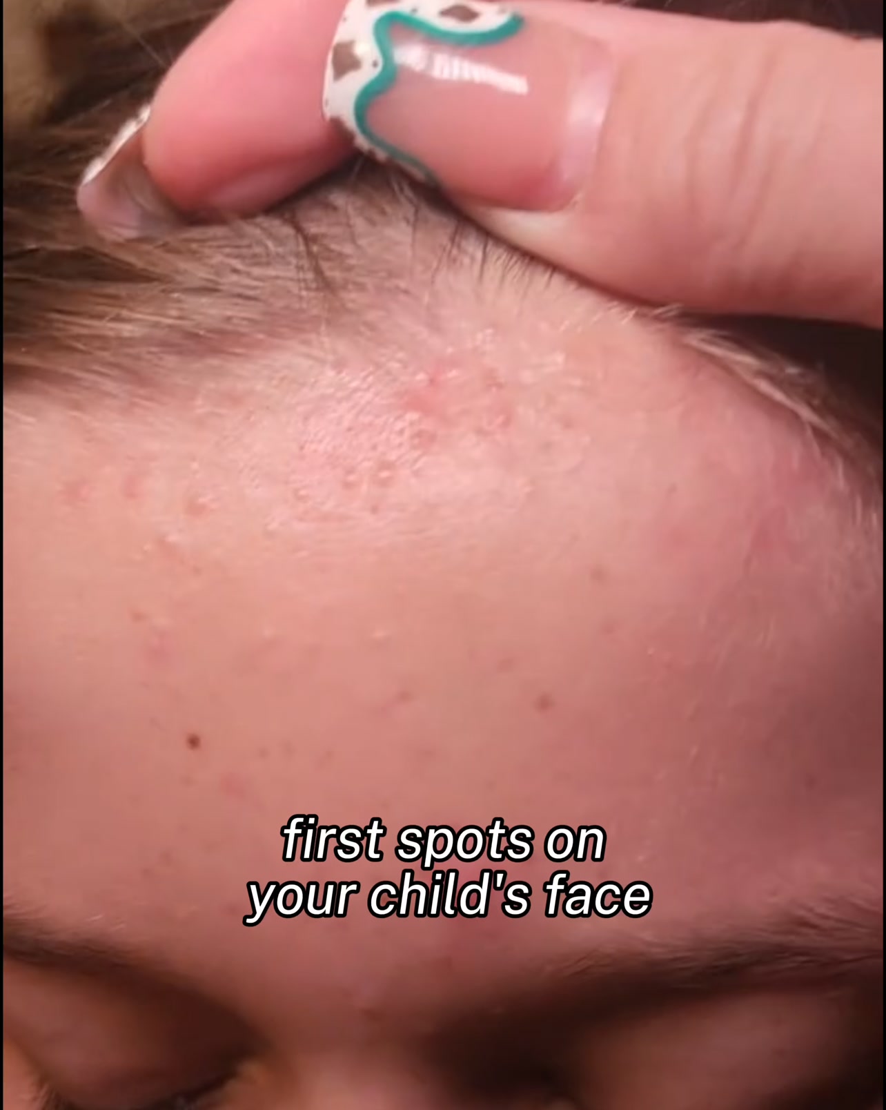 Get rid of spots!