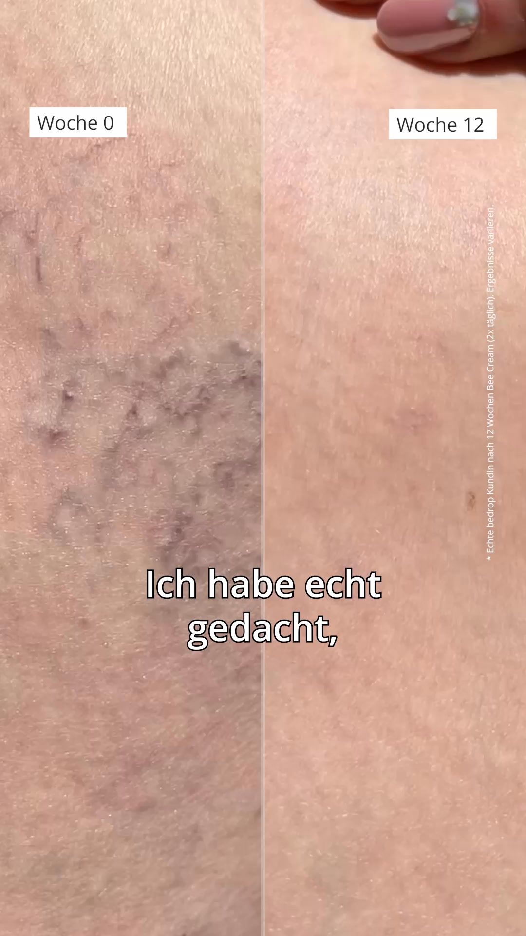 Besenreiser? Deutschlands #1 Bienengift-Creme
