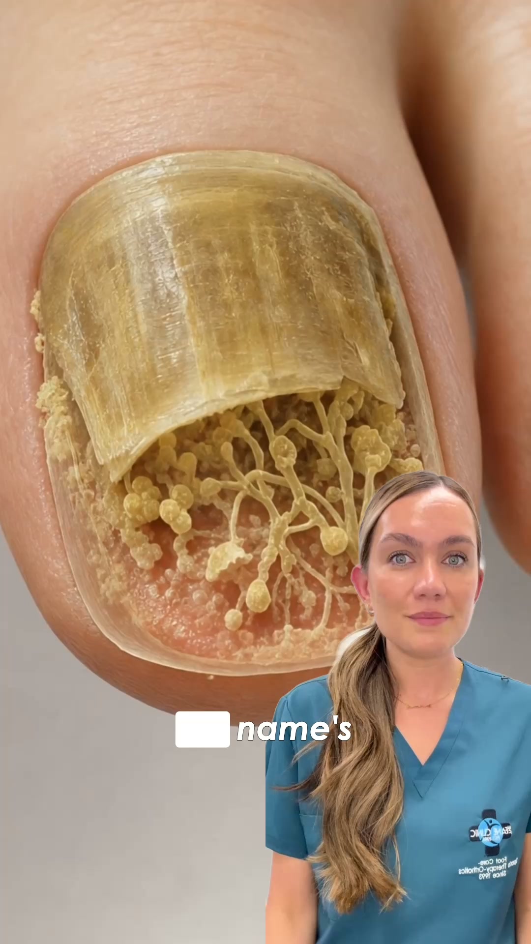Fungal Nails? Find The Cause