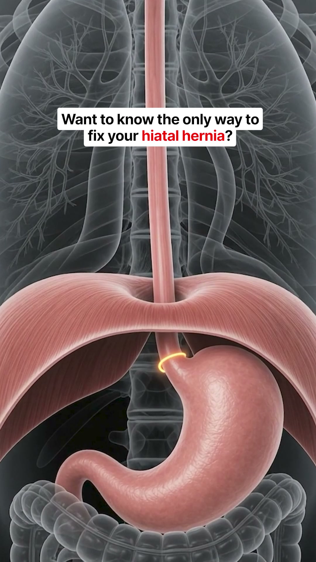 Reflux Relief Without an Acid Blocker