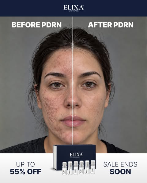 What PDRN Does for Your Acne Scars