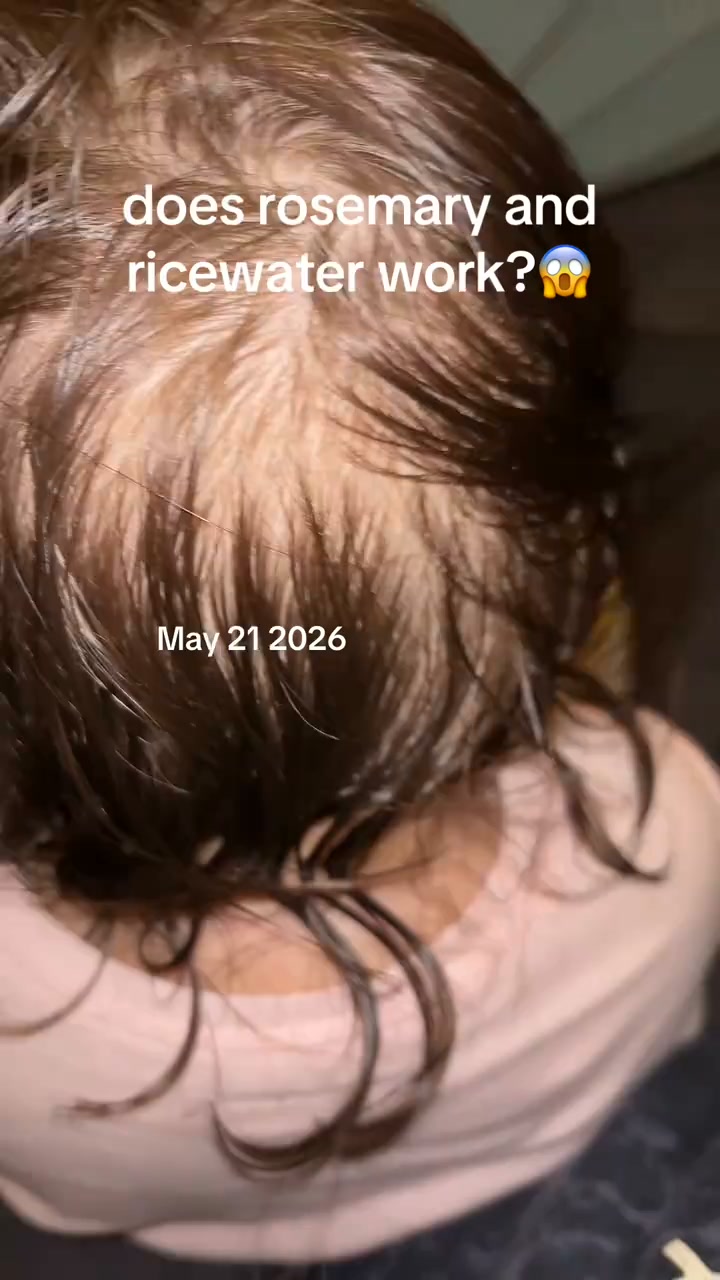 Does Rosemary & Rice Water ACTUALLY Work for Thinning Hair? See the Proof!