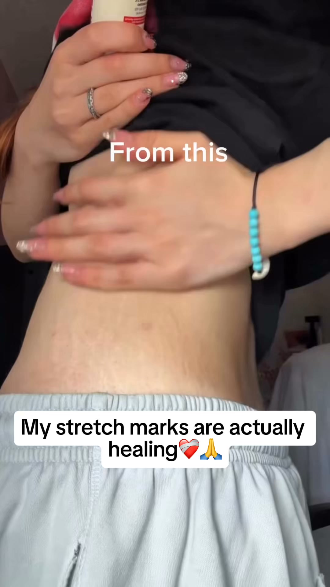 Smooth The Look Of Stretch Marks