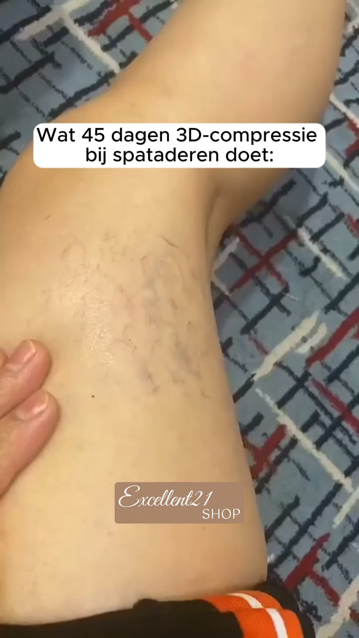 Lipoedeem vraagt andere ondersteuning