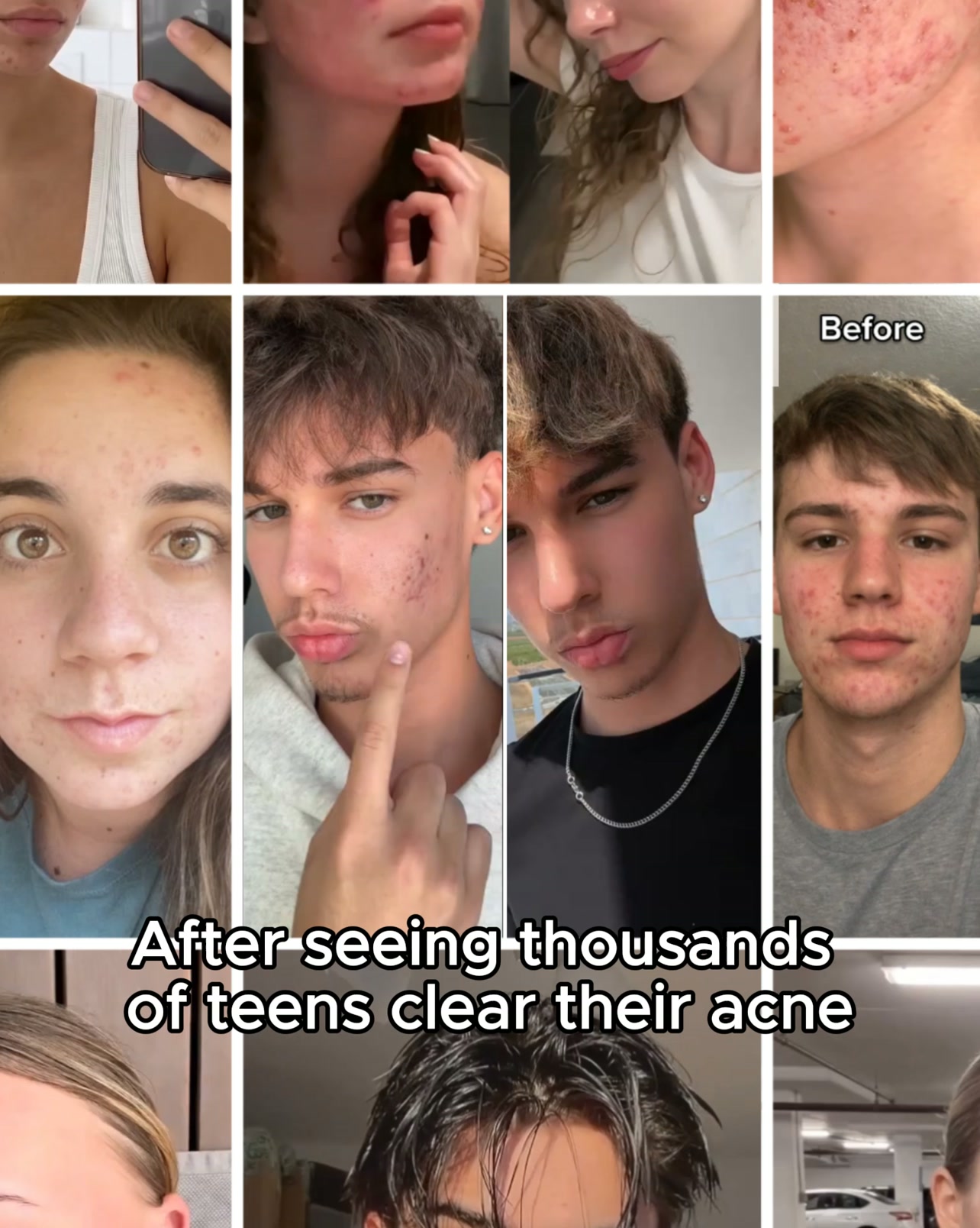 Stop acne now!