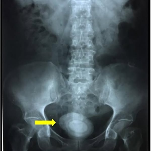Every woman with recurring UTIs needs to see this