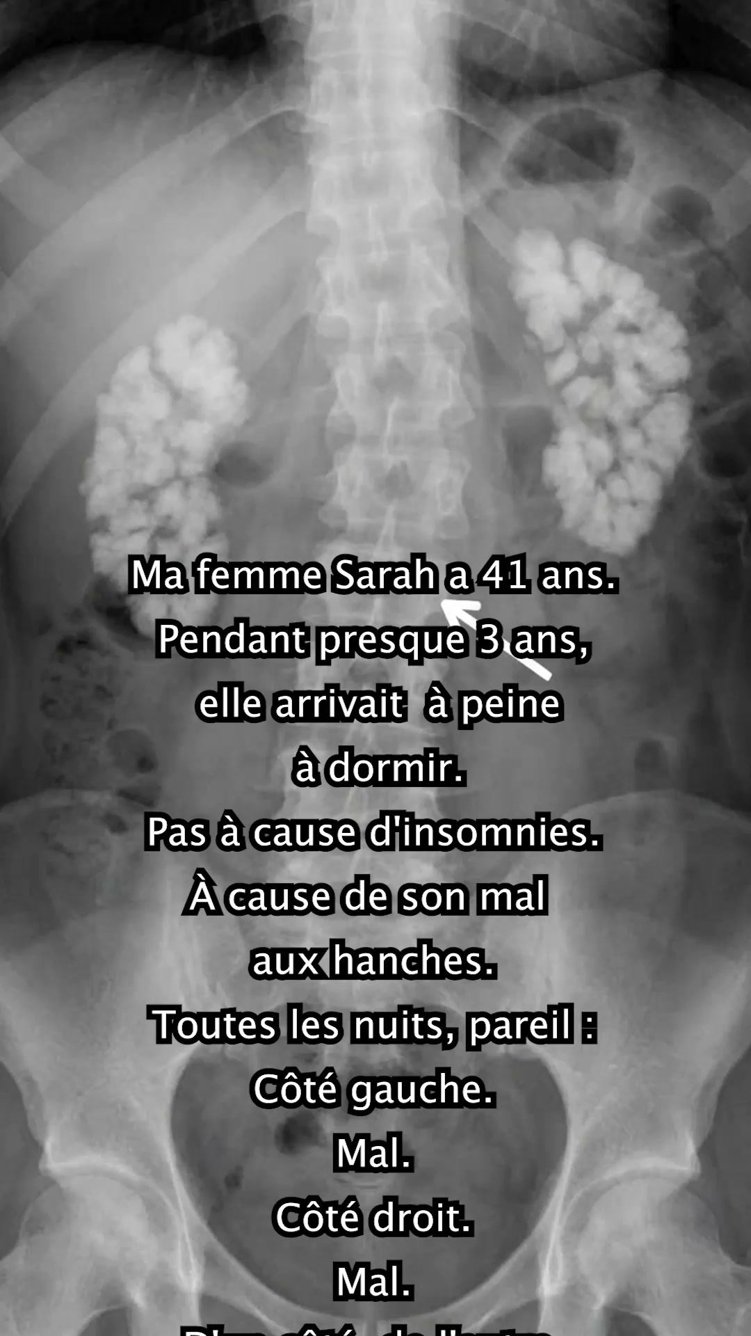 La solution n°1 contre la sciatique