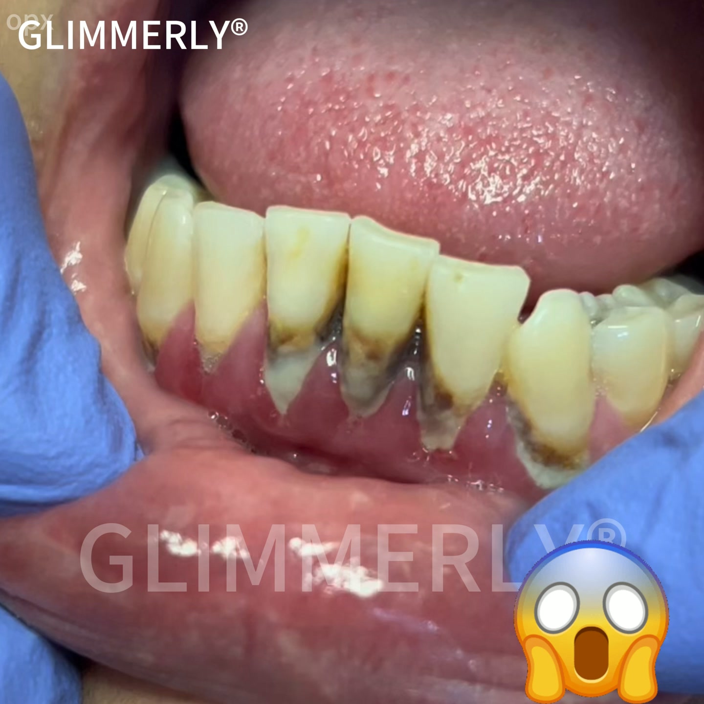 Wyprodukowano i wysłano w Polsce | Certyfikat CE | Potwierdzona skuteczność według norm Polskiego Towarzystwa Periodontologicznego