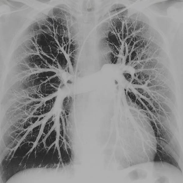 The cough that never left