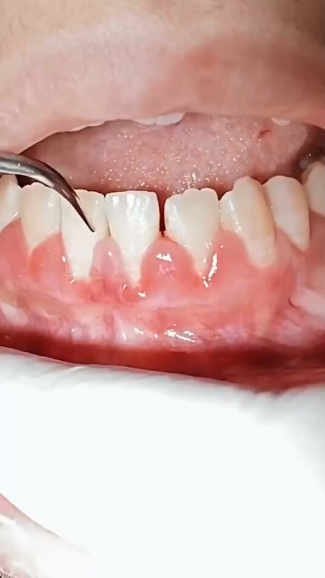 1 Gomma che trasforma i tuoi denti