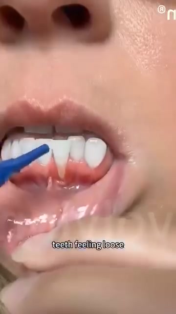 Endorsed by the American Academy of Periodontology (AAP)