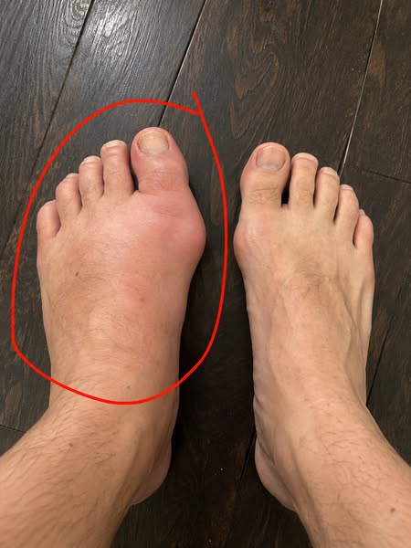 Get Your Life Back From Gout