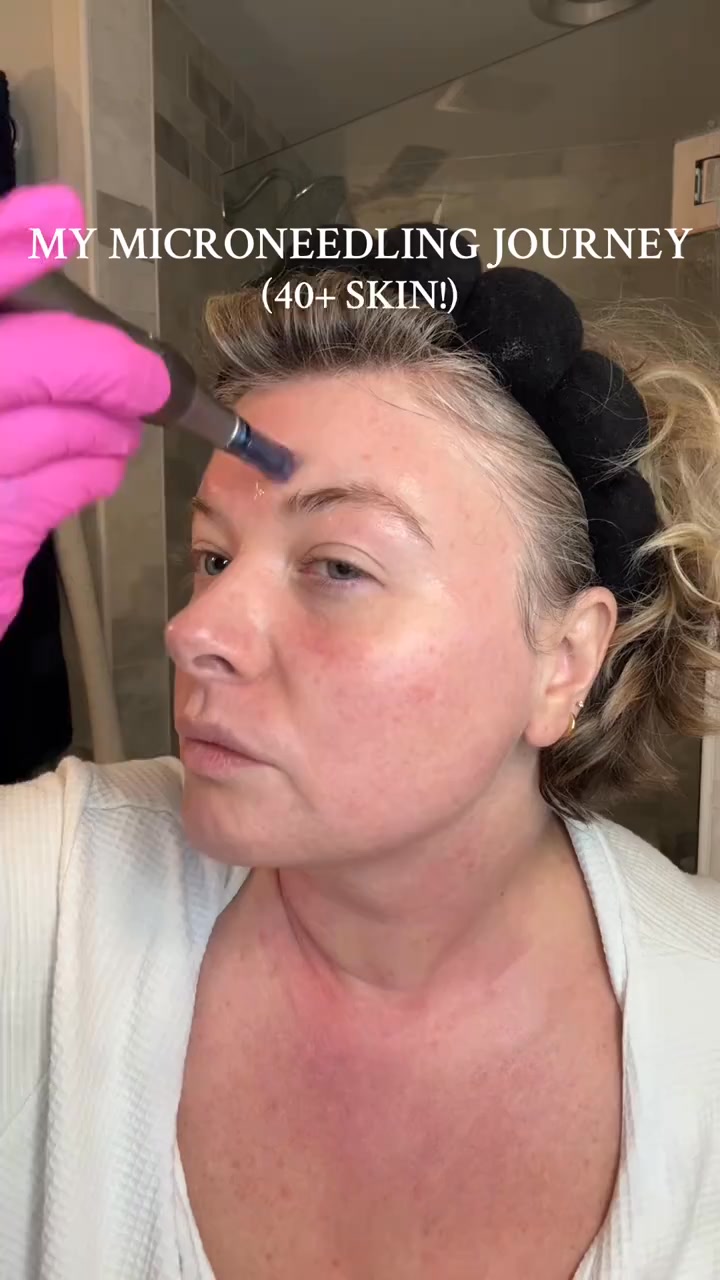 Why Women Are Microneedling At Home