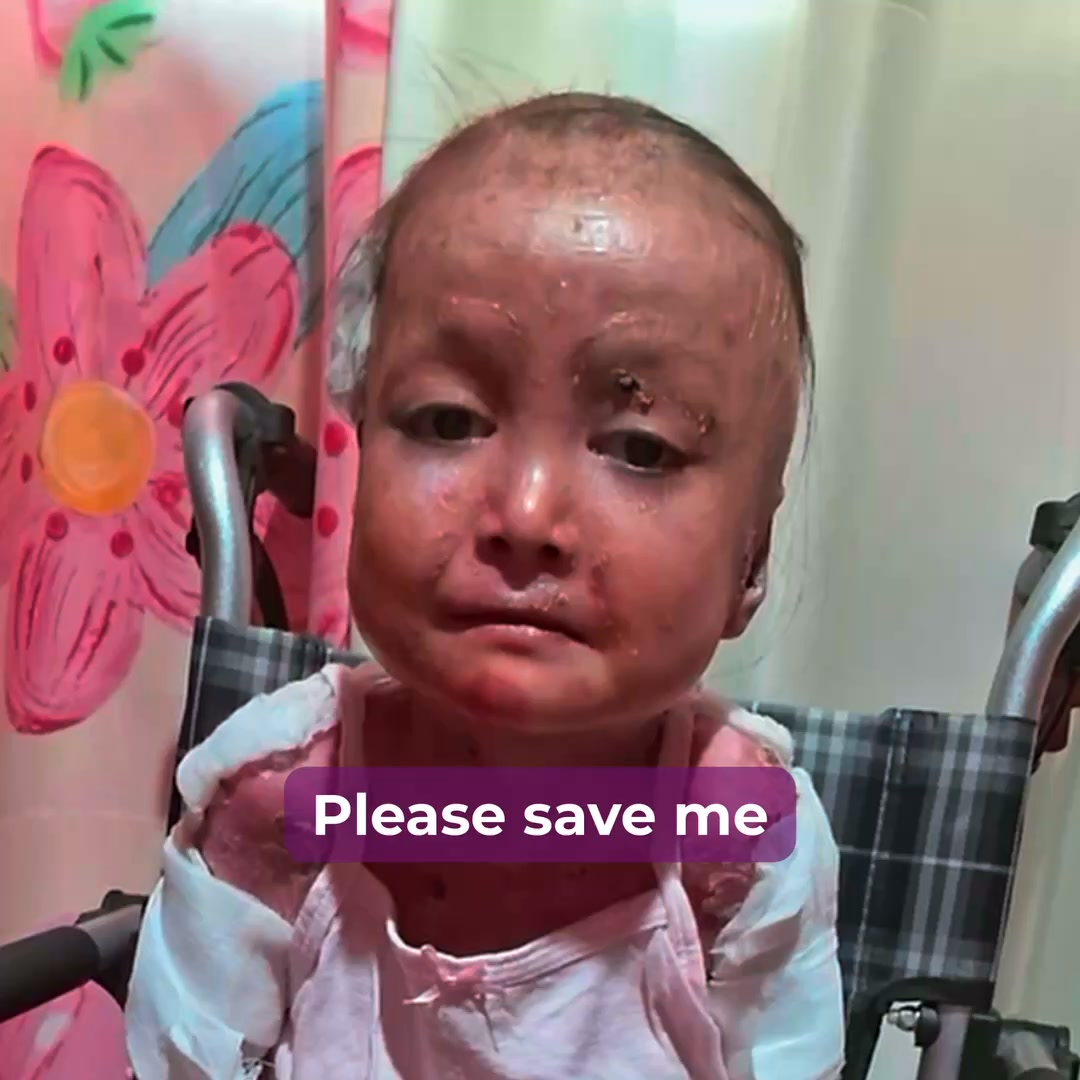 Shamila’s Skin Is Falling Off. Help Her.