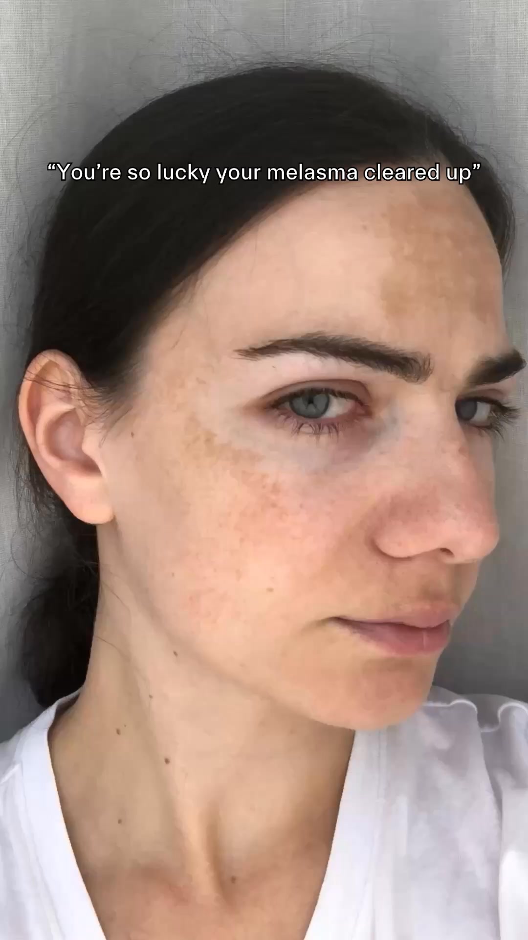 Treat melasma with a retinoids formula