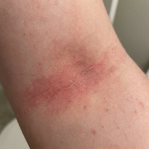 Feel Normal in Your Own Skin Again