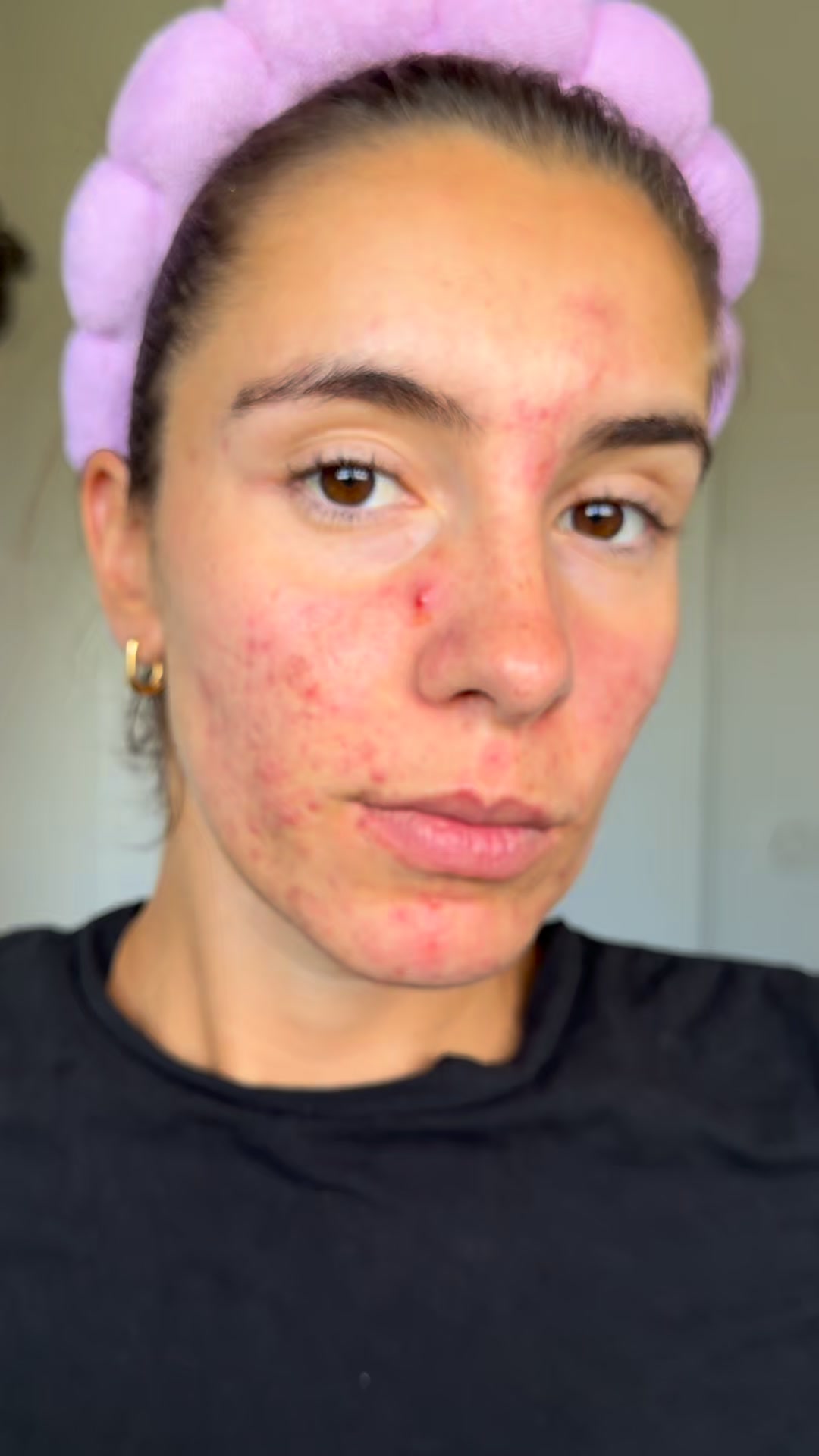 La méthode complète anti-imperfections