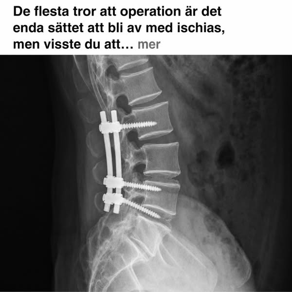 Bli av med ischias hemma? (Måste läsas)
